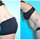 Before and After - 6 months post op