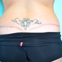 incisions 6 months post op