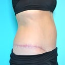 incisions 6 months post op
