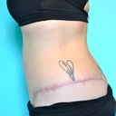 incisions 6 months post op