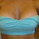 3 WEEKS POST-OPT