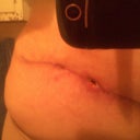 left side with wound where drain was that I accidently pulled 1 week post op. getting better day by day