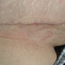 my scar up close, its really fading well and very low.