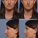 Before pics in the left column, and computer imaging in the right column. I also had a chin implant imaged in the right column, but I decided against it.