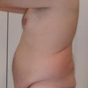 Day of surgery 12-7-12