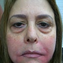 This is after the initial 1 1/2 vials...red and swelling went away in 5 days