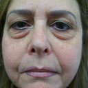 This is right before the first procedure....note the mouth area