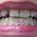 Day 1 With Invisalign 8-20-12