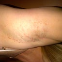 Left Pit Night of Procedure