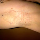 Right Pit Night of Procedure