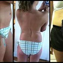 2 days Pre-Op lipo of flank area