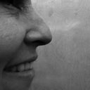 Right side nose/eyelid PreOp.