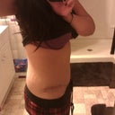 3 months post op. You can see my swelling here. Took this picture after eating dinner.