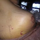 Day 4 breast lift and smart lipo