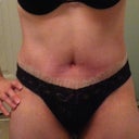 18 days PO front view - swelling is there but getting better