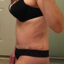 18 days PO side view - swelling is there but getting better