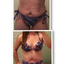 Bikini before & after - 18 days PO