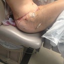 2 days PO - bruising from the outer thigh lipo