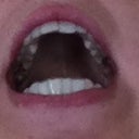 Spacing on front teeth