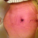 Three days post op. not too bad