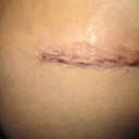 Up close incision, winkled, pinched and raised.  Scary but I KNOW it will be fine later. PO day 3