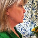 This is a photo before the surgery on April 10th, 2012.