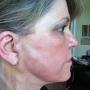 One week after surgery around April 18th.  The lumpiness went away by week 4.