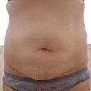Day before tummy tuck surgery, front view.  April 2010
