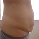 Side view, day before tummy tuck surgery