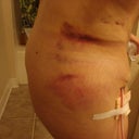 Day after tummy tuck surgery.  All bruised up from the lipo and can't stand up straight.