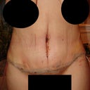 Week 1 after tummy tuck.  Still bruised but improving.