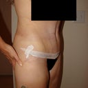 Week 3 after tummy tuck.  Side view.  Stomach flattening out and I'm standing up straight.