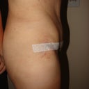 Week 4 after tummy tuck.  Another side view.