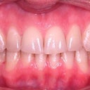 Front view, after some tooth reshaping. My ortho said he will shape them more once the whole process is complete and the bite is fixed.