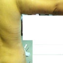 Photo3: 4 weeks after vaser. My arms are still swelling but my mom said "your arms look smaller and  better than first photo