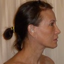 Nearly five years post-op, no makeup, age almost 58.