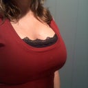 30 Days Post-Op