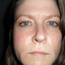 Close up, a few hours after injection. Just minor redness under one eye which was gone in two days.