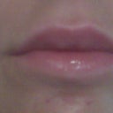 The day after injections (upper lip is still pretty swollen)