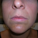Before injections