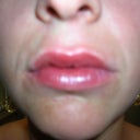 Immediately after injections