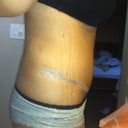 13 days po fluid buld up makn me pudge