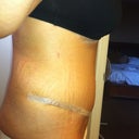 2 weeks po swelling/fluid down a little