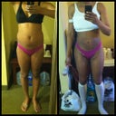 3/1/12 day before surgery front and the day after surgery 3/3/12