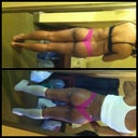 3/1/12 day before surgery back and the day after surgery 3/3/12