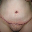 Day 3 post op-front view. Looks crooked, but not standing straight.