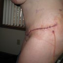 Left side view with drain.  Had touch of lipo done here too that caused the bruising,