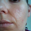6 months after fraxel, left cheek