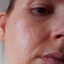 6 months after fraxel, right cheek