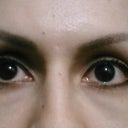 5 months. I'm not wearing any foundation, only powder, so I think this is going to be pretty much my final result. I still have hollowness, but compared to how the bags were, I'm ok with this. Wish it was perfect, but at least my vision and muscles weren't damaged :-)